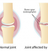 Does Glucosamine Chondroitin Help knee and Joint Pain Due to Osteoarthritis?