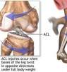 How to Prevent ACL Injuries