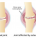 Does Glucosamine Chondroitin Help knee and Joint Pain Due to Osteoarthritis?
