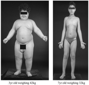 leptin treatment for leptin deficiency