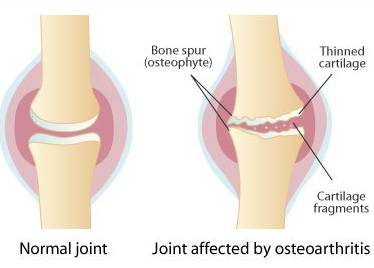 glucosamine chondroitin for osteoarthritis pain