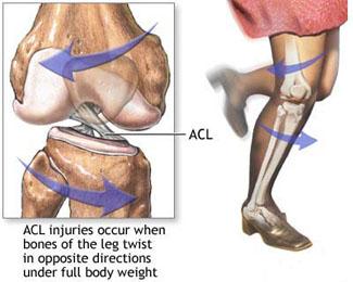 ACL Injury mechanism